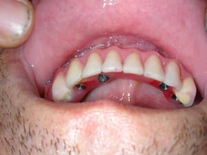 Bridge sur 6 e54q7b - Eugenol