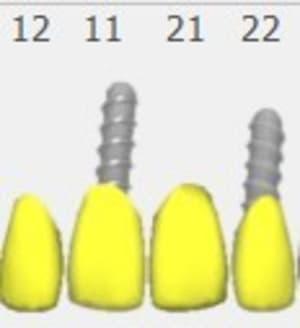 Bridge sur implant 11 22 2 svltsu - Eugenol