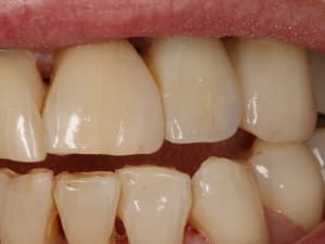 Bridge vectris hnvdsj - Eugenol
