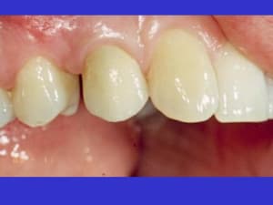 Cas esthétique z55ipz - Eugenol