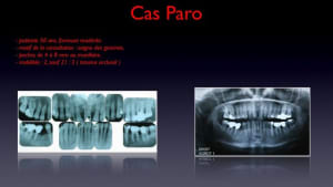 Cas paro - Eugenol