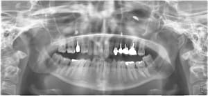 Casesurg cww8n7 - Eugenol