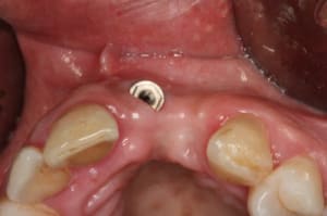 Caso clinico 1 - Eugenol