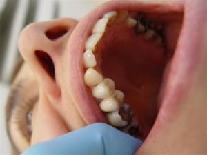 Cerec  encore une pmautre vue ls0etd - Eugenol