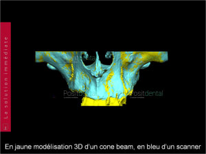 Chirurgie guidée 011 nuqrfs - Eugenol