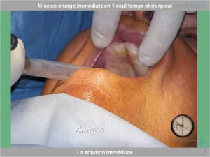 Chirurgie guidée mise en charge immédiate 0003 ylggge - Eugenol