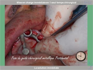Chirurgie guidée mise en charge immédiate 0007 dzqra6 - Eugenol
