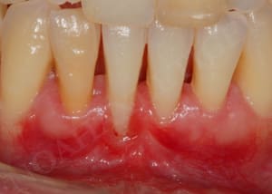 Cicatrisation a2aisn - Eugenol