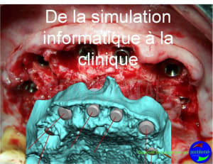 Cicatrisation gingivale suite eimci positdental 9 ehj5s3 - Eugenol