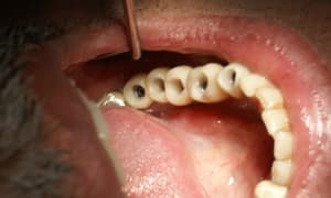 Cinq caries wv0buf - Eugenol