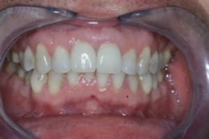 Controle à 6 mois vnjicq - Eugenol
