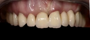 Couronne et bridge nuqbil - Eugenol