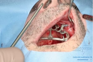 Déoulé d une mci dr r - Eugenol