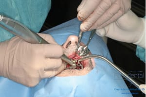 Déoulé d une mci dr r - Eugenol