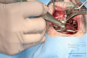 Déoulé d une mci dr r - Eugenol