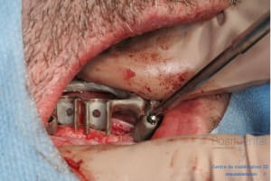 Déoulé d une mci dr r - Eugenol