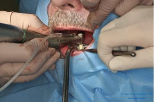 Déoulé d une mci dr r - Eugenol