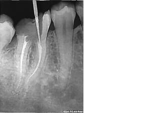 Dent radio dent img qurcqf - Eugenol