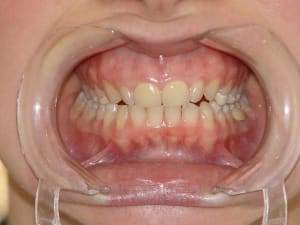 Dentosophie isa occlusion à 6 mois yu9bbl - Eugenol