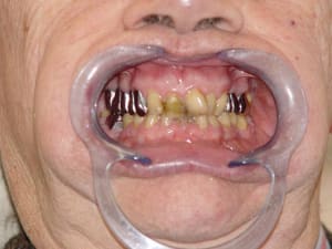 Dentosophie occlusion début de traitement hko6ed - Eugenol