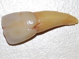 Dinte u1mrjp - Eugenol