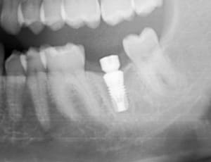 Easyimplant nwxgse - Eugenol