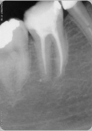 Endo2 hmenzw - Eugenol