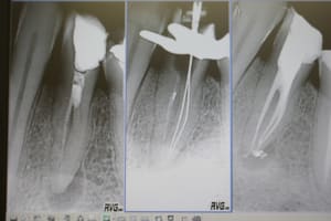Endo pm 3 canaux 001 xfpy1i - Eugenol