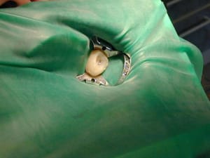 Endo maintenant kreuny - Eugenol