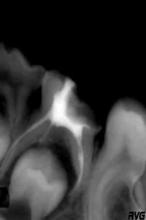 Endo molaire lact ale s6qhio - Eugenol