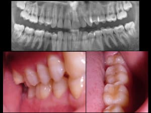 Erosion 36 otnkdm - Eugenol