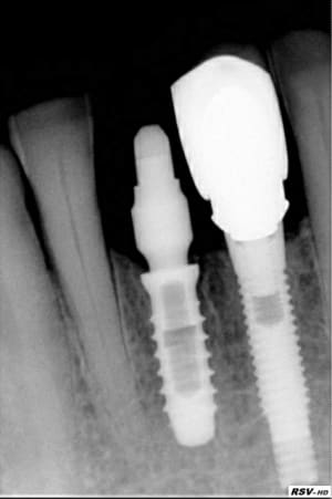 Ext imp   3 mois lpadks - Eugenol