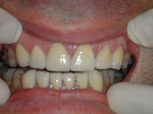 Facettes 1 27 07 2005 21 33 42 vnv439 - Eugenol