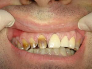 Facettes 3 06 07 2005 23 17 08 nptg3w - Eugenol