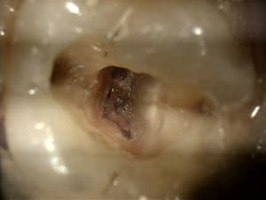 Fissure1 - Eugenol