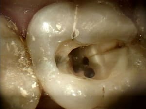 Fissure2 - Eugenol