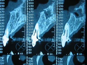Fracture1 dzggeg - Eugenol