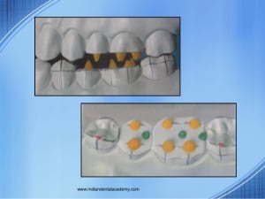 Funl occlusal waxdental courses 25 638 wxi8si - Eugenol