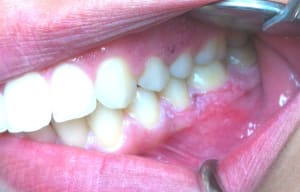 Gingivite1 nmq0lg - Eugenol