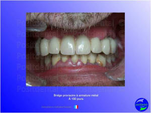 Guide chirurgical   mise en charge imm diate 014 sh120l - Eugenol