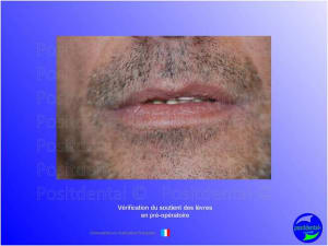 Guide chirurgical   mise en charge imm diate 017 brz0pd - Eugenol