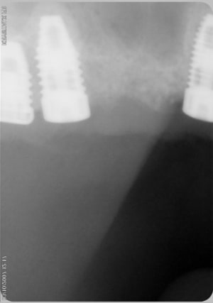 Implant2 vhqnks - Eugenol