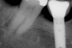 Implant4 dmzasm - Eugenol
