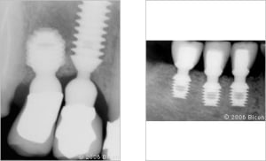 Implant court eyuf1y - Eugenol