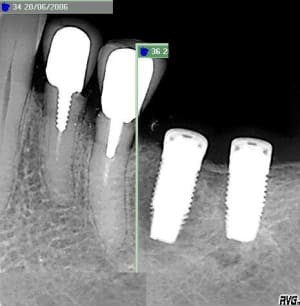 Implant image pas nette x2c9bu - Eugenol