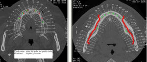 Implant maxillaire fkcqts - Eugenol