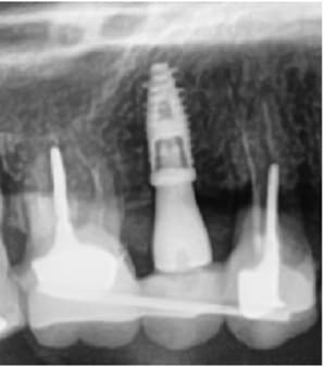 Implant p24lhh - Eugenol