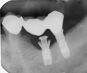Implant s3rrzq - Eugenol