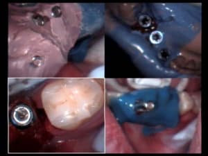 Implants aurélia 02 04 2005 empreinte xg3y5v - Eugenol