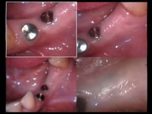Implants aurélia 02 04 2005 one xzfhnr - Eugenol